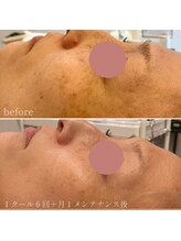 グラント(grant)/【BBL】ビフォーアフター