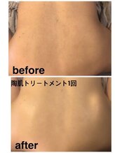 エッグスキン 豊田(egg skin)/REVIハーブピーリング　背中