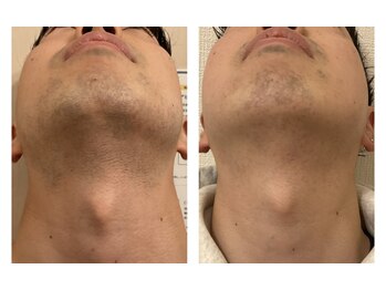 リリウム(Lilium)/脱毛｜ヒゲ脱毛