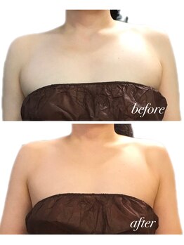 リリィブラン(Lily branc)/ブライダル痩身