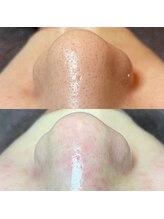 トトサロン(toto salon)/毛穴エクストラクションtete式