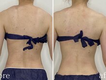 カプリス(CAPRiCE)/リンパドレナージュ