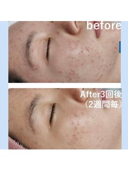 ミアローザ(Mia Rosa)/ニキビケア