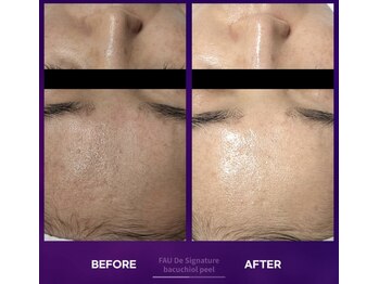 マスカレード 品川(Masquerade)/バクチオールピール美白