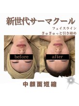 クリニカルボーテ 心斎橋院(CLINICAL BEAUTE)/ぼやけたフェイスラインがキュッ
