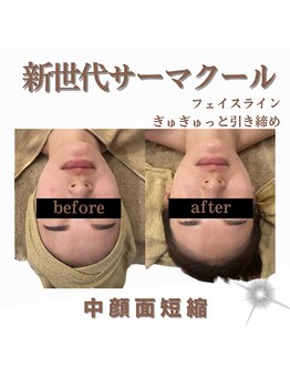 クリニカルボーテ 心斎橋院(CLINICAL BEAUTE)/ぼやけたフェイスラインがキュッ