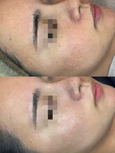 フルール ニコ(Fleur Nico)/6回のBeforeAfter