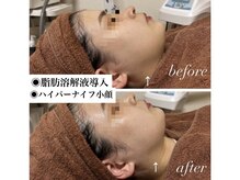 ソレラ(sorelle)の雰囲気(脂肪分解液導入×ハイパーナイフ小顔)