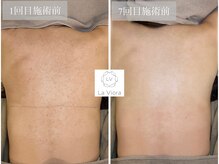 ラヴィオーラ 川崎(La Viora)/ダイヤモンドハーブピーリング