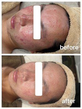 ベリス(BELLIS)の写真/【本気の肌質改善】色々なケアで効果を得られなかった方にお勧め！一緒に理想の美肌を目指していきます♪