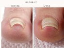 巻き爪改善ケア