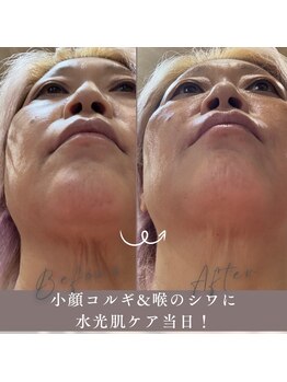 エステリワールの写真/本格コルギ&水光肌ケアで輝く艶肌へ！施術当日で首のシワが目立ちにくい仕上がりに◎