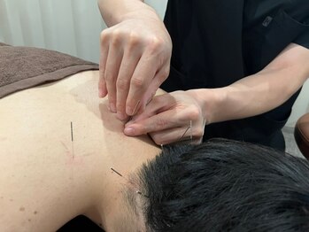 かがやき整体院 十三/【鍼施術】