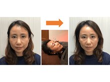 レメディ/美容鍼スペシャルコース