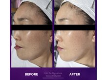 マスカレード 品川(Masquerade)/バクチオールピール美白