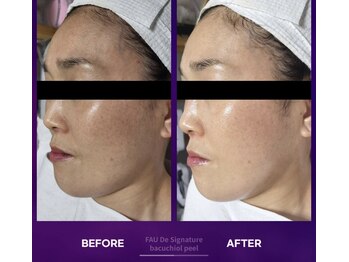 マスカレード 品川(Masquerade)/バクチオールピール美白