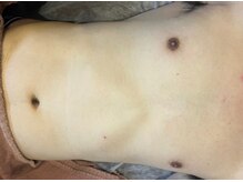 ヨハク(YOHAKU)/20代後半　男性　７回施術after