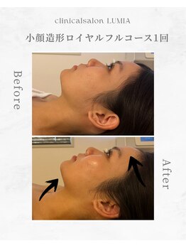 ルミア(LUMIA)/小顔造形ロイヤルフルコース１回