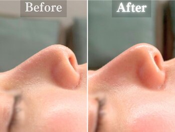 ボーンオム(Born Homme)/毛穴洗浄+美容液導入:20代女性