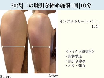京都フォーエイチ(京都4H)/30代|二の腕引き締め|施術1回