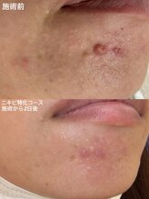 グラーティア 奈良王寺店/ニキビ特化コース★経過★