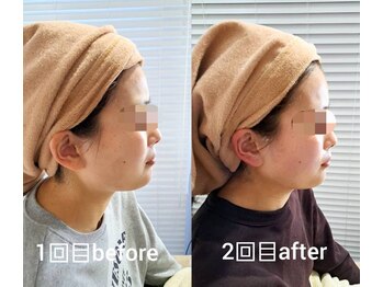 リノブルーム(LINO Bloom)/高周波マシンサーマトリックス