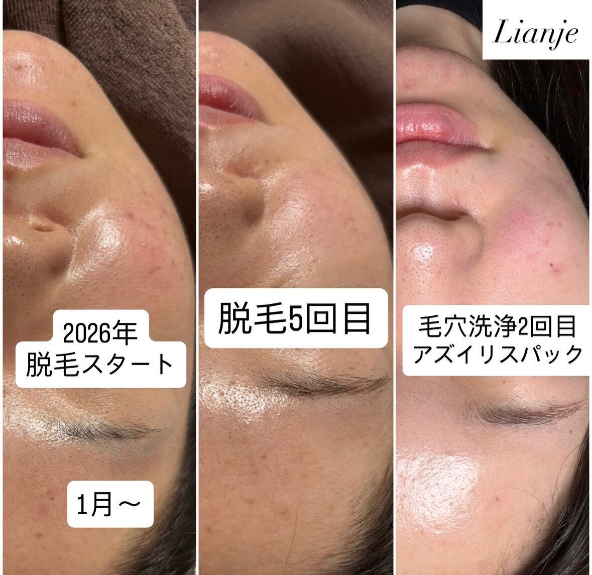 新潟市中央区で毛穴黒ずみが人気のエステサロン｜ホットペッパー