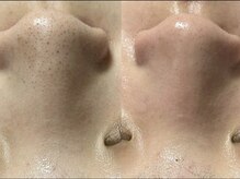 とぅるりん 肌質改善の雰囲気（黒ずみ毛穴一掃！毛穴洗浄もオススメ♪施術に掛け合わせ可能♪）