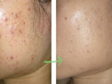 サロン ド プロデュース(salon de PRODUCE)/毛穴、気なる方効果大！