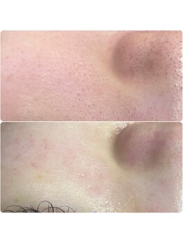 プアラ(puala)/頬もキレイ