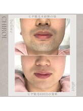 チロル(CHIROL)/ヒゲ脱毛