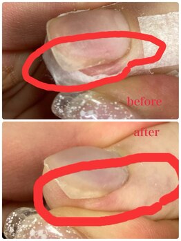 爪処 中野坂上/巻き爪ケア