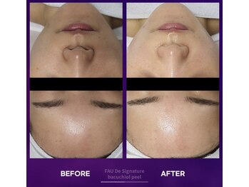 マスカレード 品川(Masquerade)/バクチオールピール美白