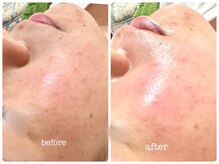 シシエル(CHICIEL)/フェイシャルワックスで透明感♪