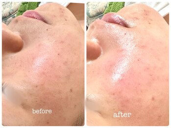 シシエル(CHICIEL)/フェイシャルワックスで透明感♪