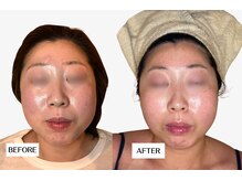 エングラッシー(en glassy)/BEFORE　AFTER　20代