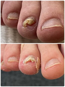 巻き爪じゅん 千葉駅前店/巻き爪変形を改善！健康な爪へ