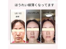 ミヤビ(MIYABI)の雰囲気(月2回のラジオ波+低周波リフトとホームケアでかわりました。)