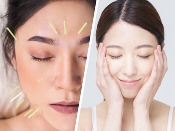 トゥルン(Tworun)の写真/「くすみが気になる」「顔が暗く見える」など、年齢とともに出るお悩みは≪美容鍼+毛穴洗浄≫で解決！
