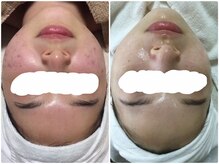 ビズビズ 天王寺店(bisebise)/ニキビ/毛穴開き黒ずみ角栓詰り