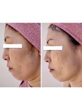 ビジュー(bijou)/50代のお客様/小顔/よもぎ蒸し/