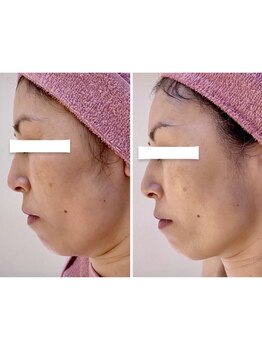 ビジュー(bijou)/50代のお客様/小顔/よもぎ蒸し/