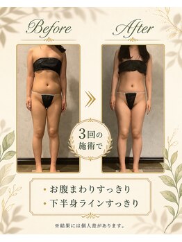 リンガ(Ringa)/3回で実感すっきり変化