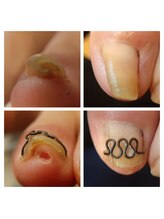 フットサロンアーチ 新小岩/巻き爪の劇的ビフォーアフター
