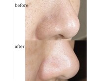 リュミエール デスポワール(Lumiere d'espoir)/毛穴洗浄