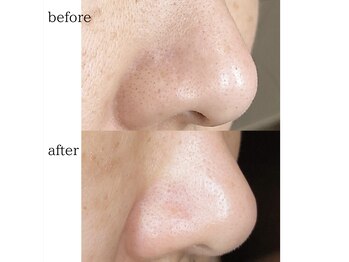 リュミエール デスポワール(Lumiere d'espoir)/毛穴洗浄