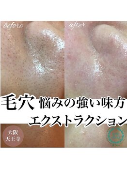 アンク(Ankh)/毛穴悩みの強い味方