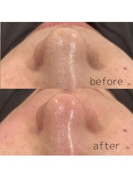 サラ(Sala)/アンプルフェイスワックス