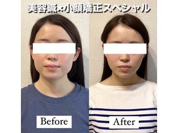 ハリカ 恵比寿 代官山店(HARIKA)/長年のエラ張り/左右差は美容鍼