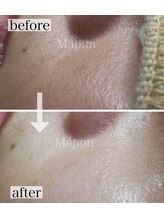 マプン(Mapun)/お肌の綺麗は毛穴のお掃除が肝心